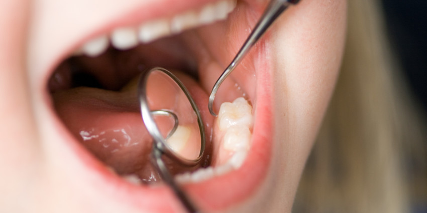 Dentista examina boca do paciente | Como prevenir as cáries?