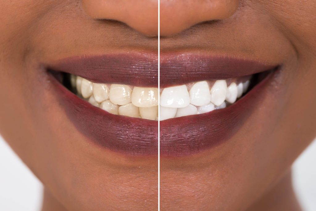 Montagem de mulher sorrindo, com metade da imagem com dentes amarelados e, na outra metade, dentes brancos | Cuidados ao fazer um clareamento dental